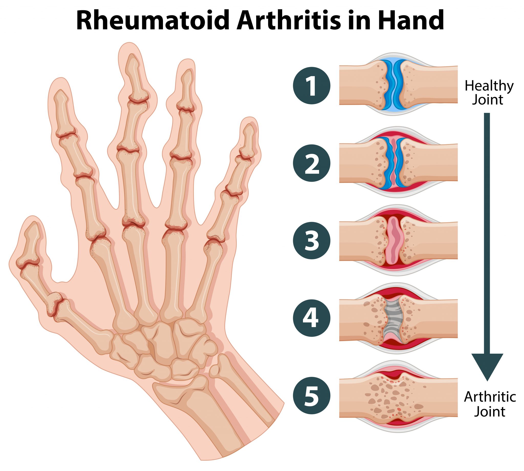 Arthritis Symptoms,Causes and Treatments